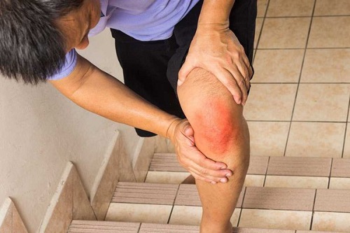 viêm khớp gối ảnh hưởng tới sức khỏe chất lượng cuộc sống của người bệnh